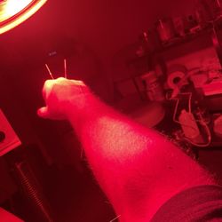 Nature Healing Center - Injured finger