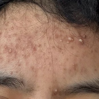 Metropolis Dermatology - How I first came in the office - Dermatologists Near Me - Costa Mesa, California Metropolis Dermatology - How I first came in the office - Dermatologists Near Me - Costa Mesa, California
