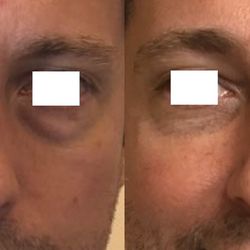 Metamorphosis Holistic MedSpa - Male Cheek (2 Versa) and Under Eye (1 Belotero) Filler