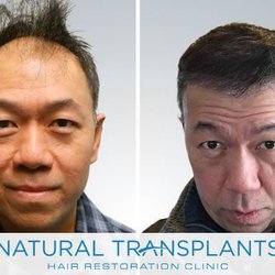 Natural Transplants, Hair Restoration Clinic