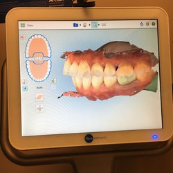 Lifetime Dentistry of Royal Palm - Before my Invisalign