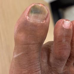 Friendly Nail Spa - Fungus under nail from dirty water at salon