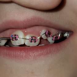SmileyCuse - Day 1- My daughters teeth were very crooked. She needed a W placed to put her teeth into the correct position.