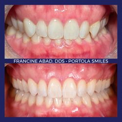Portola Smiles - Beautiful Invisalign results!