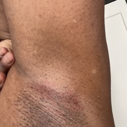 Ana Brow & Lash - Severe redness post under arm wax