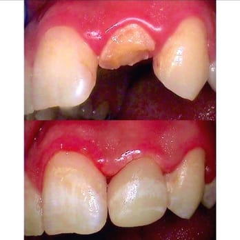 Dr. Vardanian, DDS MSD PhD - Before & after:  Patient had a broken front tooth emergency. We fixed it w/ a custom stained same day EMax crown. - General Dentistry Near Me - Roseville, California