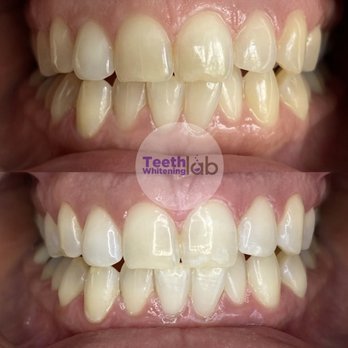 Teeth Whitening Lab  - Before and after comparison - Teeth Whitening Near Me - Long Beach, California