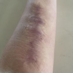 Zel Skin & Laser Specialists - Scar tissue today- two years of healing later