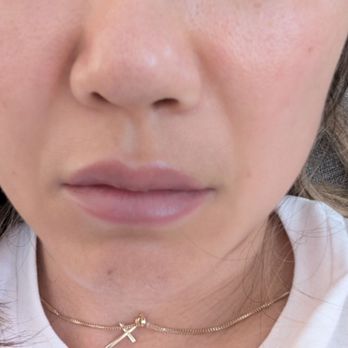 Jason Emer, MD - laugh lines are still there even after fillers were done - Dermatologists Near Me - West Hollywood, California Jason Emer, MD - laugh lines are still there even after fillers were done - Dermatologists Near Me - West Hollywood, California
