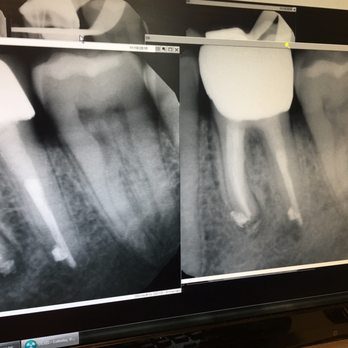 Alderwood Endodontics - Before and after 1 war later - Endodontists Near Me - Lynnwood, Washington Alderwood Endodontics - Before and after 1 war later - Endodontists Near Me - Lynnwood, Washington