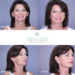 Fresh Image Cosmetic Surgery Center - Before and After