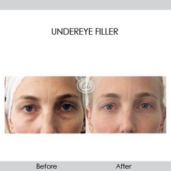 Annie Chiu, MD - The Derm Institute - Under eye filler