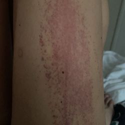 Steven L Gotlib MD PC - Rash from medications