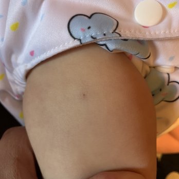 Camarena Health - Small bruise at injection site - Medical Centers Near Me - Oakhurst, California