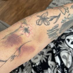BioLife Plasma Center - Hematoma