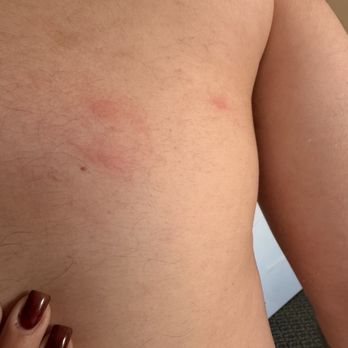 Manresa Castle - More bed bug bites - Hotels Near Me - Port Townsend, Washington Manresa Castle - More bed bug bites - Hotels Near Me - Port Townsend, Washington