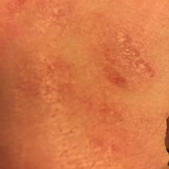 Robinhood Resort - Scabies after my stay - Big Bear Lake, CA