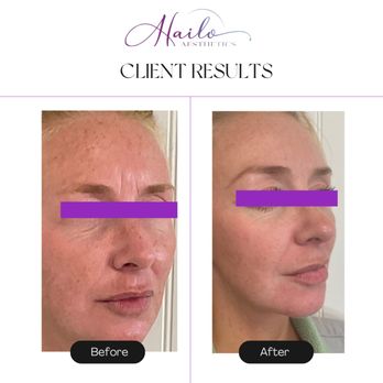 Hailo Aesthetics - Before and After results from Tox and Medical grade skincare regimine - Medical Spas Near Me - Brookfield, Connecticut