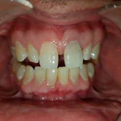 Showstoppers Teeth Whitening Studios - My brother's before teeth