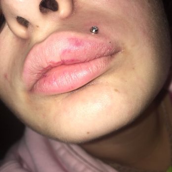 Body Designs - My lip before I got it taken out - Piercing Near Me - Deer Park, New York