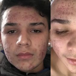 Luxury Aesthetics Center - Acne Treatment!
