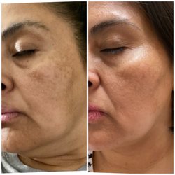 UIA Laser Center - 2 treatments of micro needling.