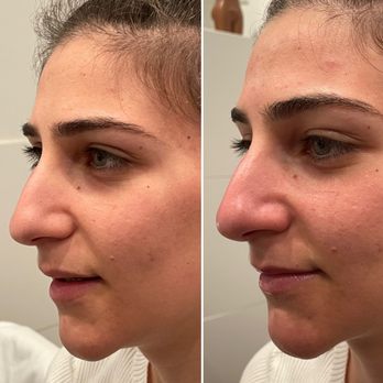 SIN.D.SMOOTH - Chemical Peel Facial - Waxing Near Me - Los Angeles, California SIN.D.SMOOTH - Chemical Peel Facial - Waxing Near Me - Los Angeles, California