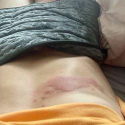 Texas Pain Intervention Clinic: Ankit Maheshwari, MD - My lupus outbreak. It gets 10 times worse than this.