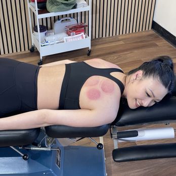 Align and Refine Chiropractic - Back Cupping - Chiropractors Near Me - Westminster, California