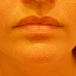 Oxana Popescu, MD - Lip augmentation before