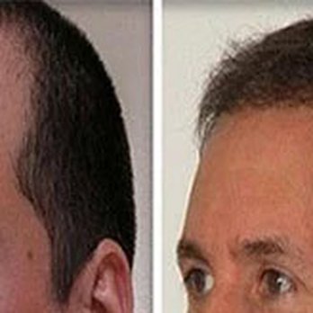 Irwin B Simon, MD - Dr. Simon of Vegas Valley Hair Restoration - Before and After photo - Doctors Near Me - Henderson, Nevada Irwin B Simon, MD - Dr. Simon of Vegas Valley Hair Restoration - Before and After photo - Doctors Near Me - Henderson, Nevada
