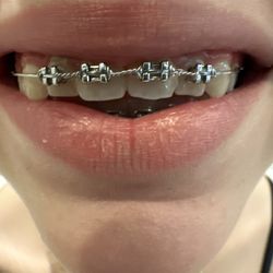 Traci R Fernandes, DDS - Coast Family Orthodontics - These two front teeth had a 1/4" gap