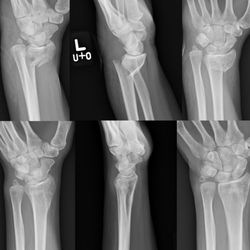 urgent+orthopedic - no surgery, cast for 1 month