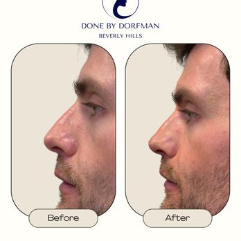 Robert Dorfman, MD - Precession Tip Lift - the perfect adjustment for men to soften the nose & keeping the masculine look vs a soft feminine look. - Cosmetic Surgeons Near Me - Beverly Hills, California Robert Dorfman, MD - Precession Tip Lift - the perfect adjustment for men to soften the nose & keeping the masculine look vs a soft feminine look. - Cosmetic Surgeons Near Me - Beverly Hills, California