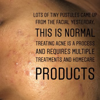 Puresthetics Skin Care - Moderate Combination Acne. - Skin Care Near Me - Cary, North Carolina Puresthetics Skin Care - Moderate Combination Acne. - Skin Care Near Me - Cary, North Carolina