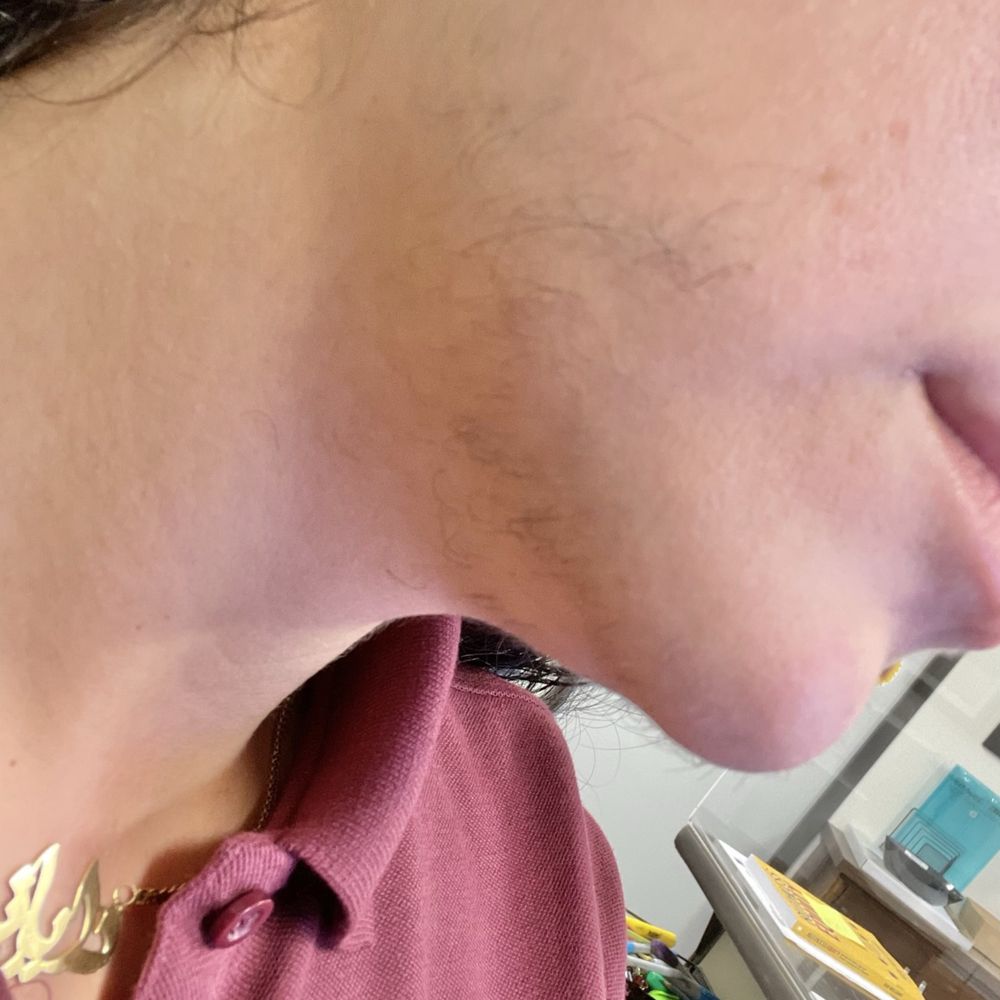 Electrolysis by Anna - Before my first session with Anna. (2 months worth of growth) - Hair Removal Near Me - Glendale , California