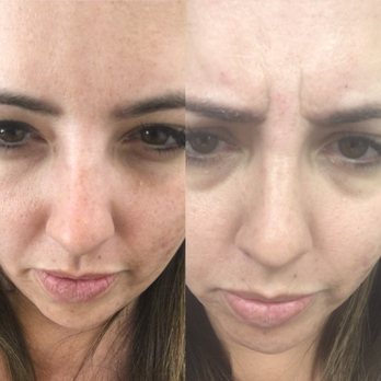 Alani Skin MD - Three days later and my frown lines are gone! Thank you Shruti! - Skin Care Near Me - Mesa, Arizona