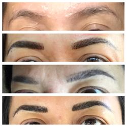 Forever Young Skin Care & Laser By Kimberly - 1st pic is my BEFORE; 2nd-right after my 1st session; 3rd-10 days after 1st session, some bare spots; 4th pic-10 days after re-touch! HAPPY!