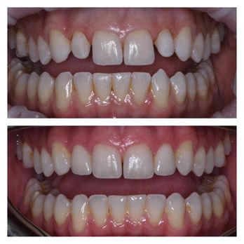Studio Dental - Two veneers can go along way. Before (top) and After (below). - General Dentistry Near Me - San Francisco, California Studio Dental - Two veneers can go along way. Before (top) and After (below). - General Dentistry Near Me - San Francisco, California