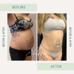 Abloom Med Spa - SmartLipo Triplex