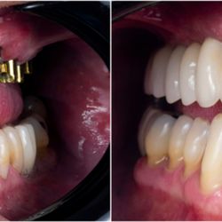 Pure Dental Smiles - Implant Case