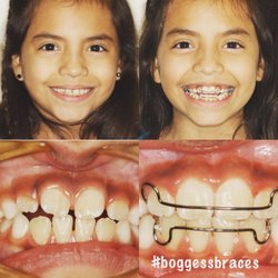 Vaughn L Boggess, DMD - Early Treatment transformation of Olivia!
