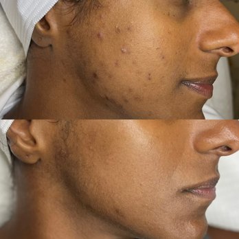 Beautopia Skin Studio - Acne program - Medical Spas Near Me - Houston, Texas
