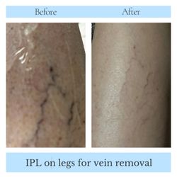 Vein reduction through IPL