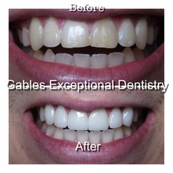 Gables Exceptional Dentistry - This patient wanted a wider and whiter smile. He brought us pictures of exactly what he wanted and is thrilled with his results!