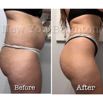 New You Brighton - Cryotherapy Near Me - Brighton, Colorado New You Brighton - Cryotherapy Near Me - Brighton, Colorado