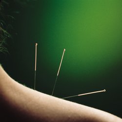 Sunrise Internal Medicine - acupuncture treatment