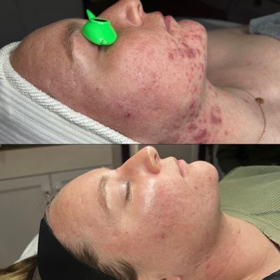 Acne Bootcamp Results - You must be on a Face Reality bootcamp regimen before you qualify for this treatment. This service includes double cleansing, a chemical peel specifically chosen for your skin's concerns, extractions, and blue light therapy. Acne Bootcamp Results - You must be on a Face Reality bootcamp regimen before you qualify for this treatment. This service includes double cleansing, a chemical peel specifically chosen for your skin's concerns, extractions, and blue light therapy.