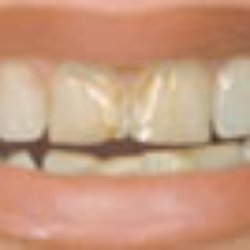 San Marcos Family Dentistry - Before Lumineers