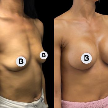 Buffalo Plastic Surgery - Breast aug before and after - Medical Spas Near Me - Amherst, New York